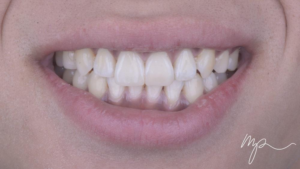 APRES orthodontie invisible adulte - invisalign - dr marin pomperski chirurgien dentiste paris 8e arrondissement00002