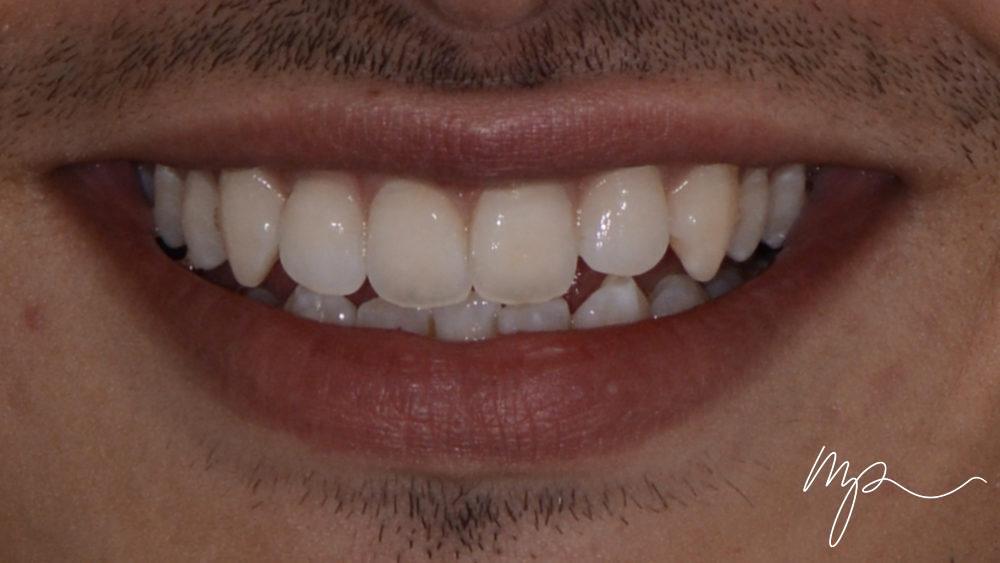 APRES taches blanches - dr marin pomperski - chirurgien dentiste00002