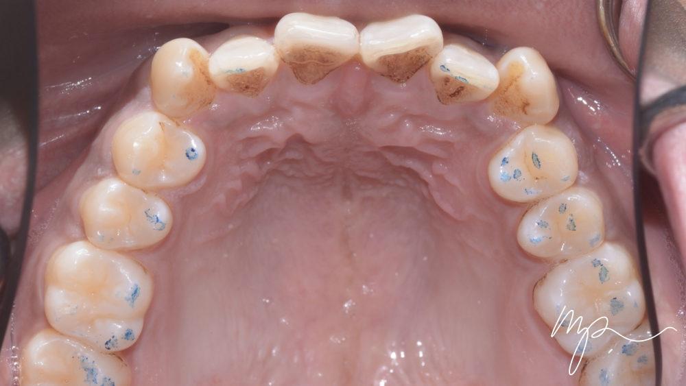 AVANT orthodontie invisible adulte - invisalign - dr marin pomperski chirurgien dentiste paris 8e arrondissement00001