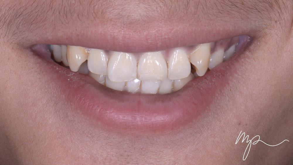 AVANT orthodontie invisible adulte - invisalign - dr marin pomperski chirurgien dentiste paris 8e arrondissement00001