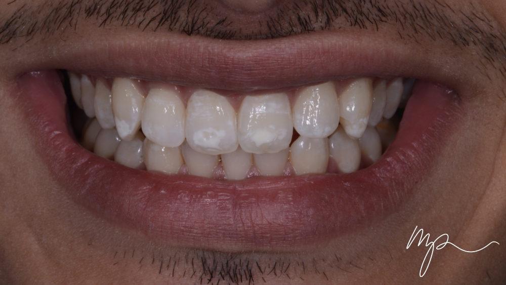 AVANT taches blanches - dr marin pomperski - chirurgien dentiste00001