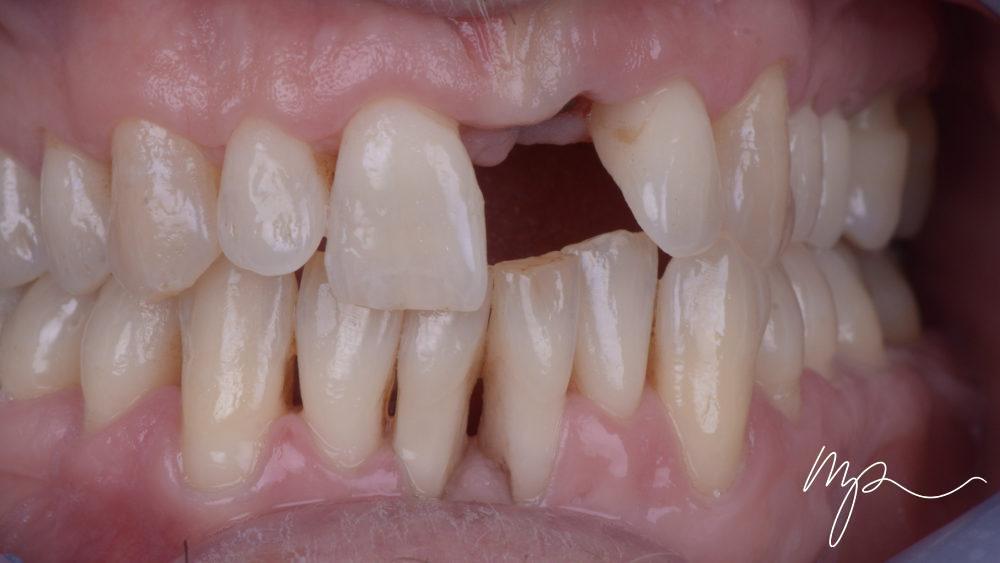 implant dentaire - dr marin pomperski - chirurgien dentiste Paris 8e arrondissemtn00001