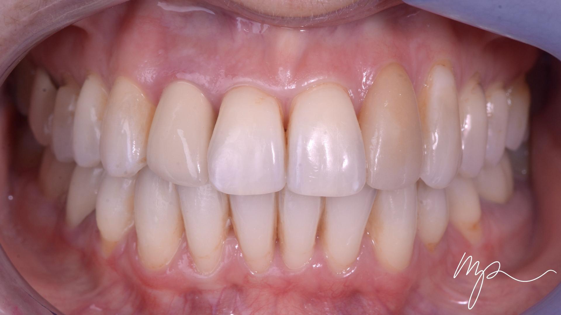 Orthodontie - dr marin pomperski - chirurgien dentiste paris 8