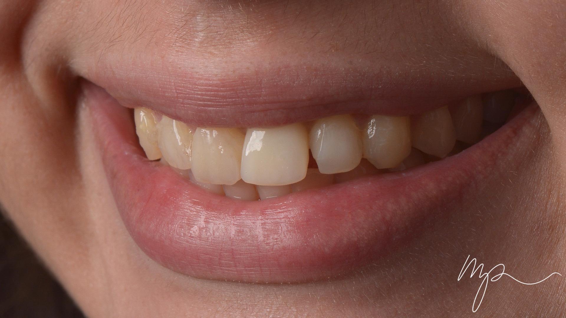 Dr Marin Pomperski - Chirurgien Dentiste - --1 Facettes Avant