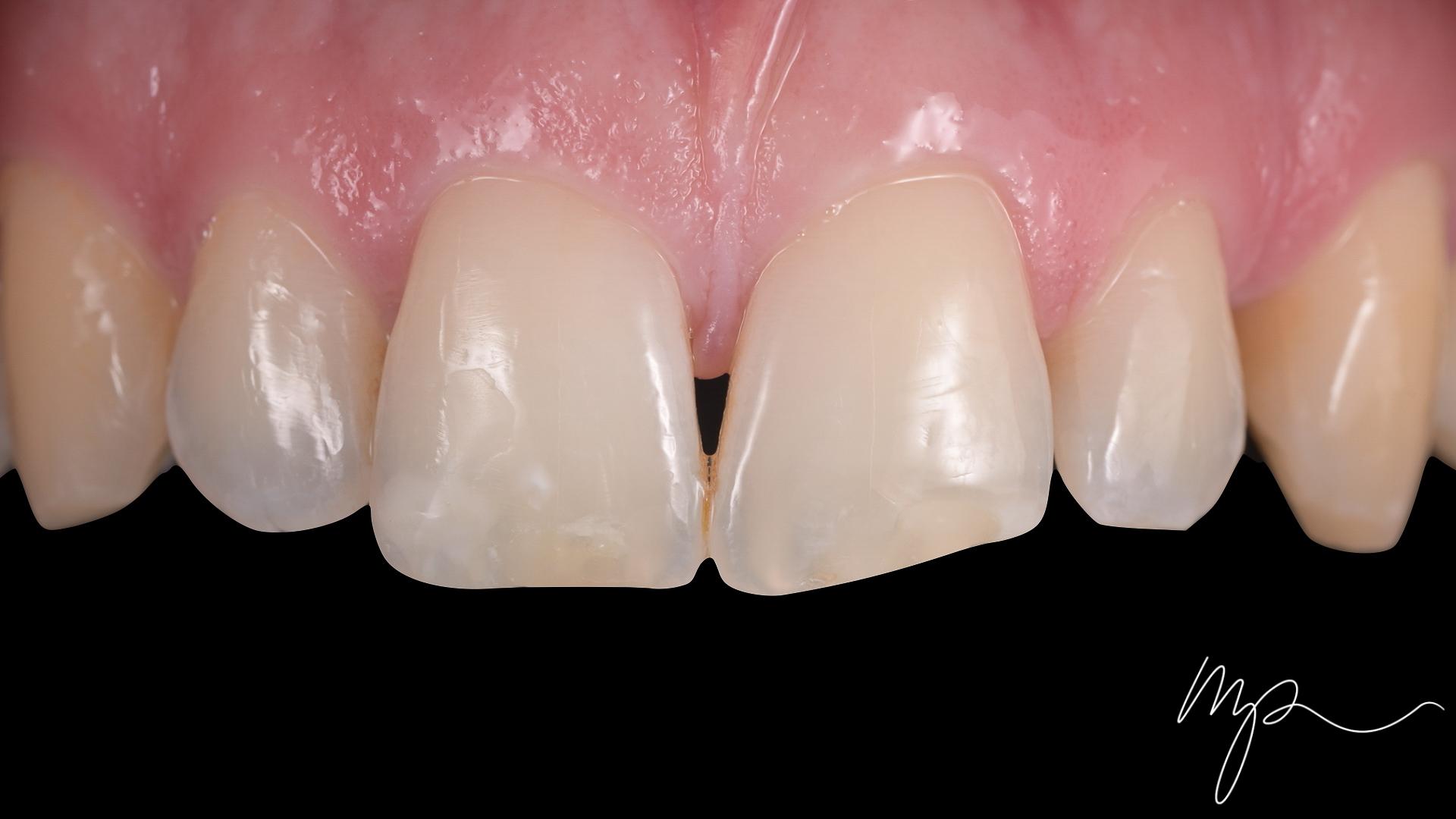 Dr Marin Pomperski - Chirurgien Dentiste - composites Avant