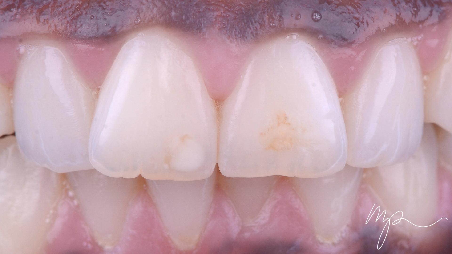 Dr Marin Pomperski - Chirurgien Dentiste - composites Avant
