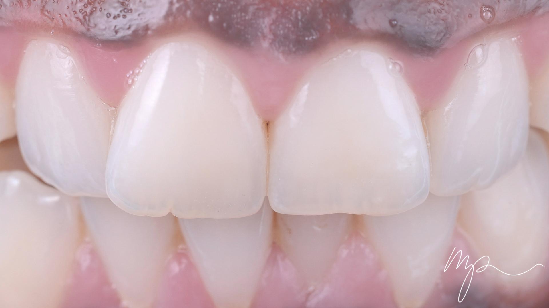 Dr Marin Pomperski - Chirurgien Dentiste - composites Apres