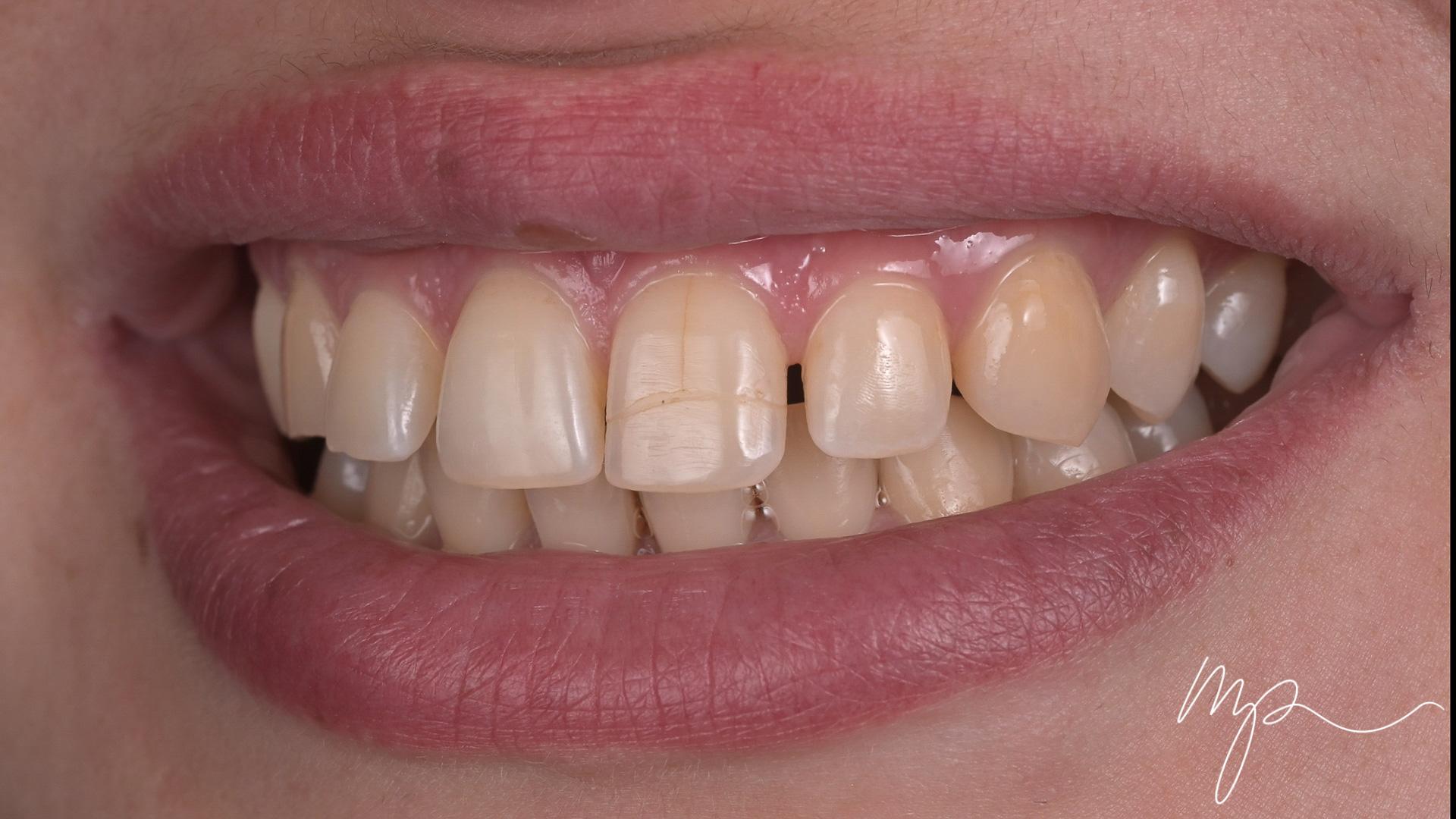 Dr Marin Pomperski - Chirurgien Dentiste - --1 Facettes Avant