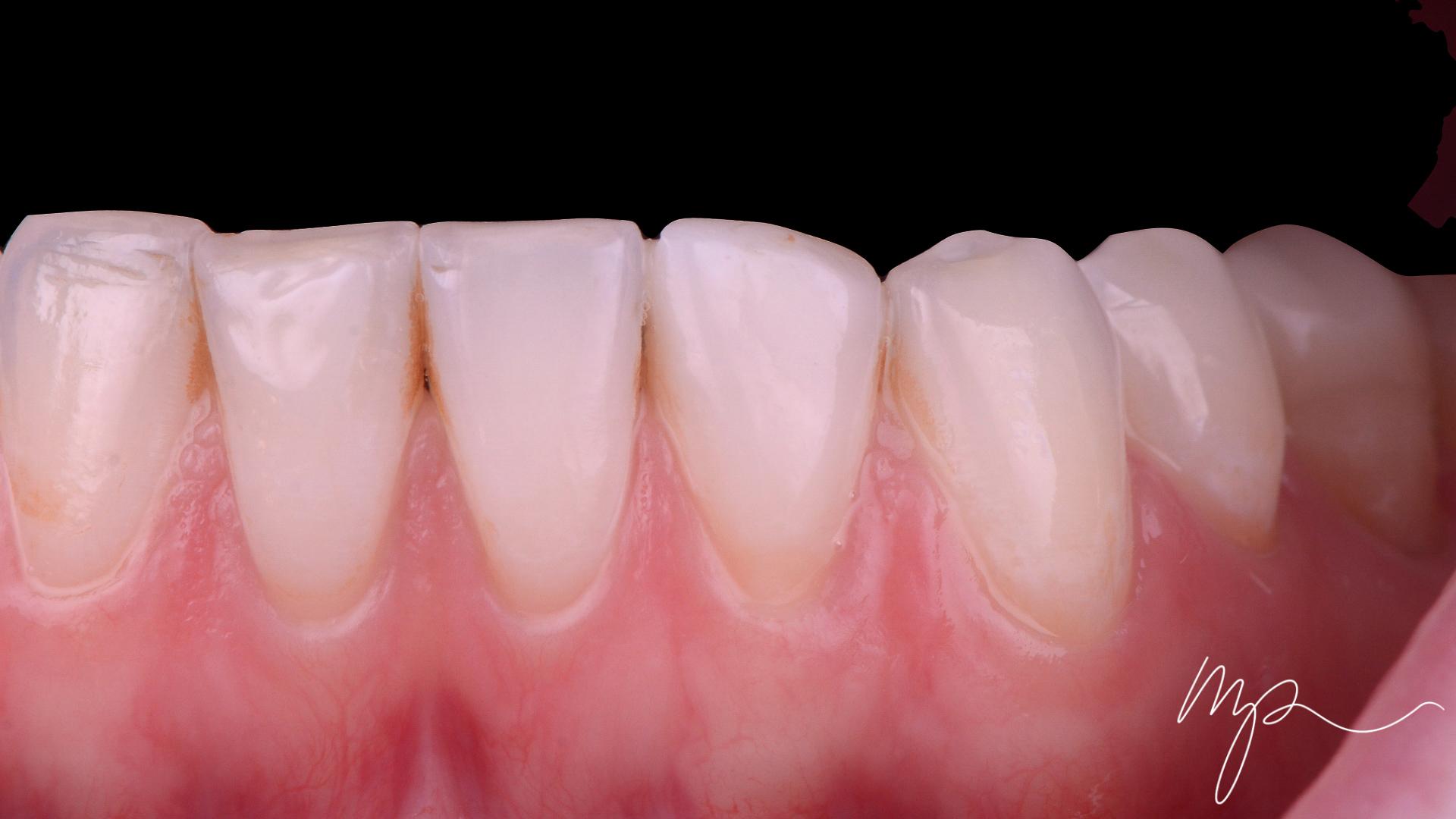 Dr Marin Pomperski - Chirurgien Dentiste - composites Apres
