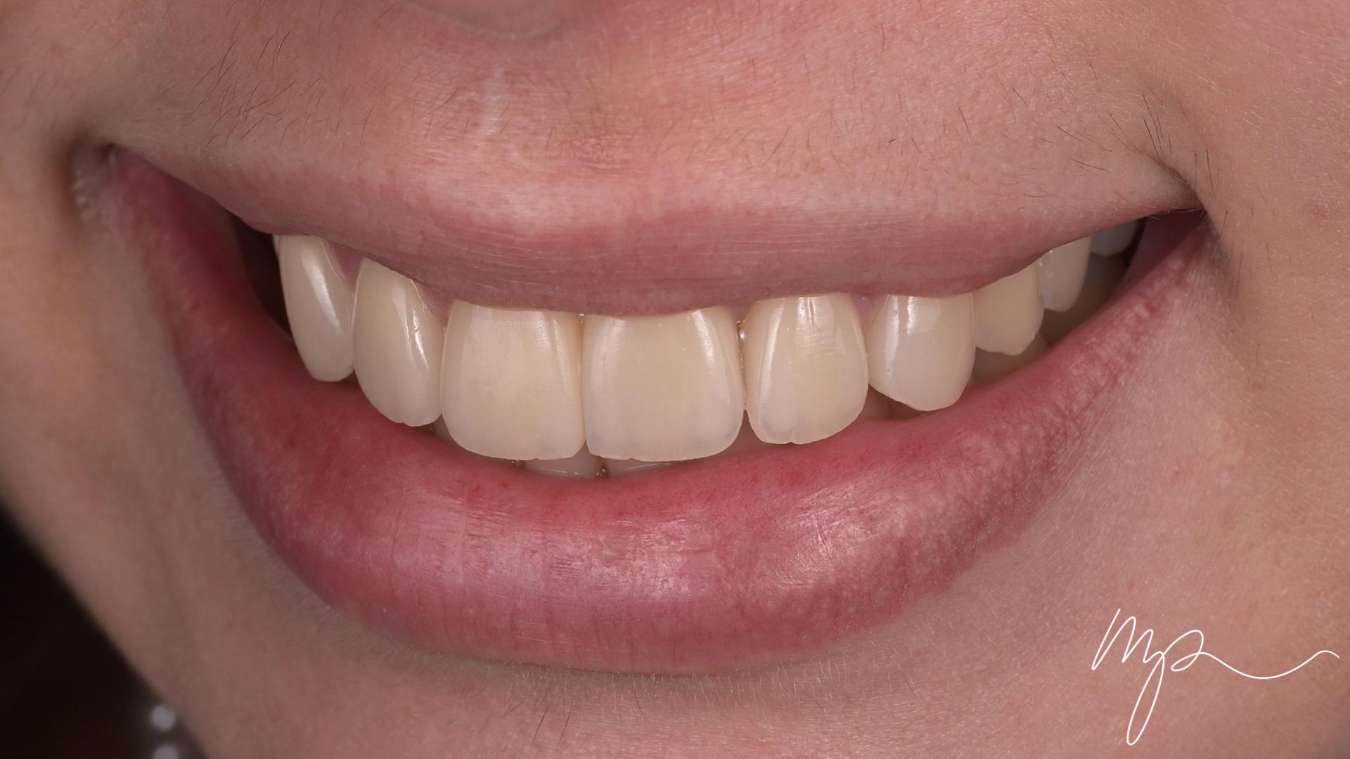 Dr Marin Pomperski - Chirurgien Dentiste - --1 Facettes Apres